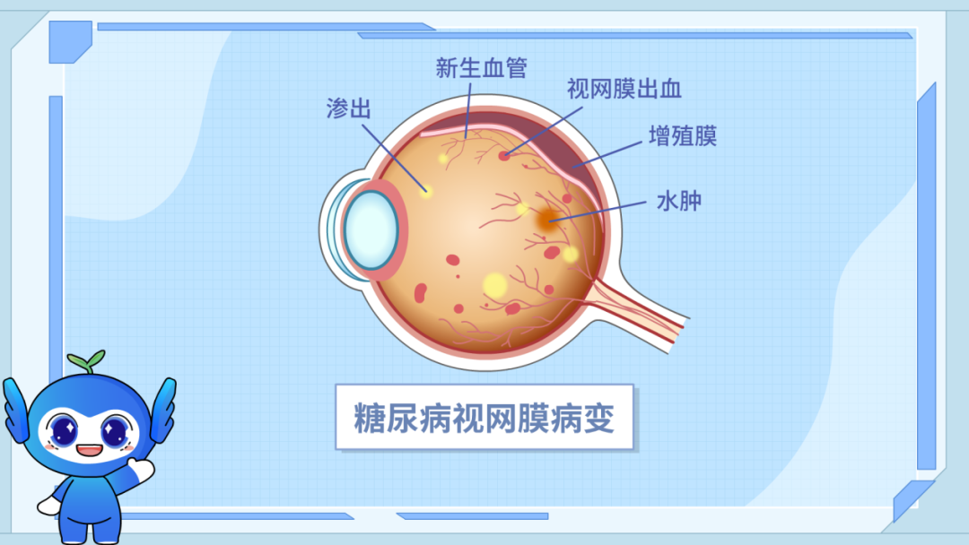 有这几个信号，可能糖尿病已经“侵蚀”你的眼