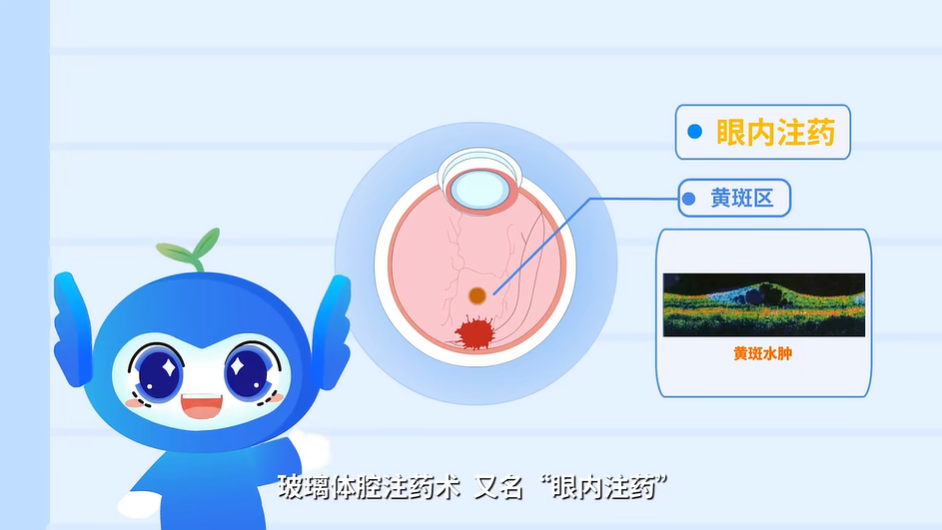 视物扭曲一定要打针吗？一文理清老年黄斑变性各类防治方案