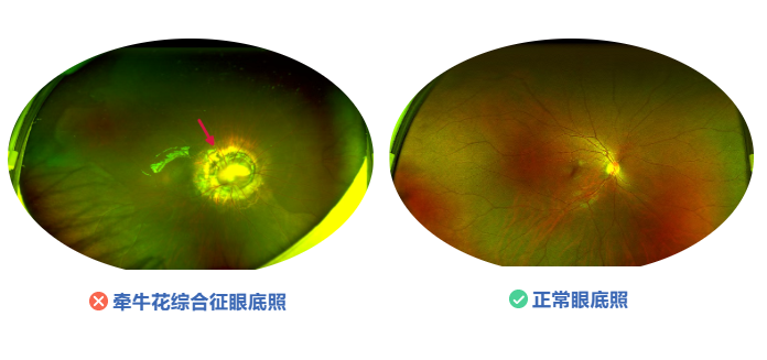 认识罕见的眼底病：牵牛花综合征